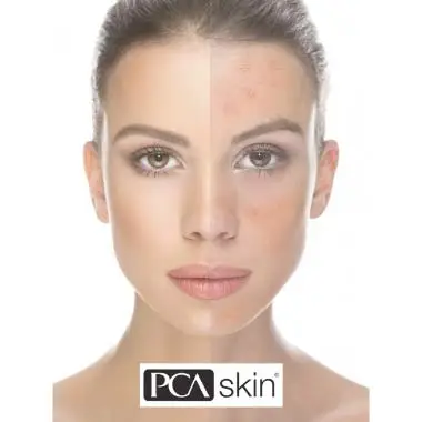 Picture of PCA Skin sample